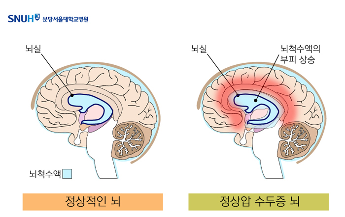 정상적인 뇌의 뇌척수액 사진과 정상압 수두증의 뇌에 뇌척수액의 부피 상승한 사진