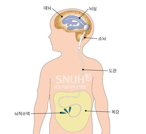 정상압 수두증의 치료방법인 션트 수술 상세설명 이미지 입니다.