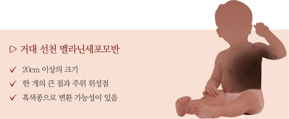 작은 점이 큰 점으로 변한 아이 모반 제거 수술(검사 과정과 비용) 3