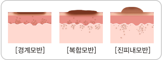 작은 점이 큰 점으로 변한 아이 모반 제거 수술(검사 과정과 비용) 7