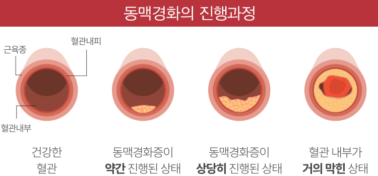 동맥경화의 진행과정