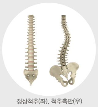 척추측만증의 척추 모습