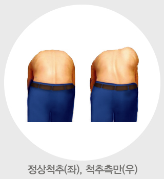 척추측만증의 허리 모양