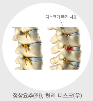 허리 디스크 사례 이미지