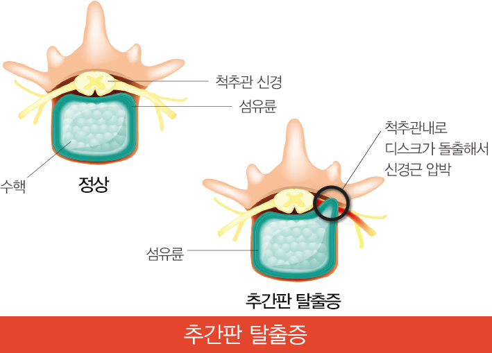 추간판 탈출증