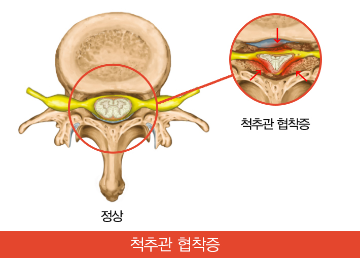 척추관협착증