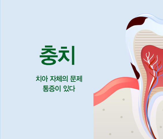 충치. 치아 자체의 문제 통증이 있다.