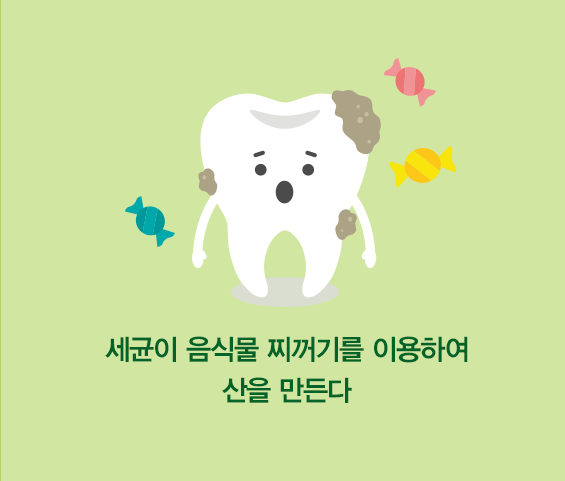 치아우식증의 원인1. 세균이 음식물 찌꺼기를 이용하여 산을 만든다.