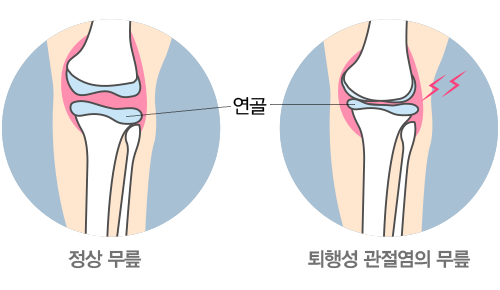 정상 무릎과 퇴행성 관절염의 연골 비교