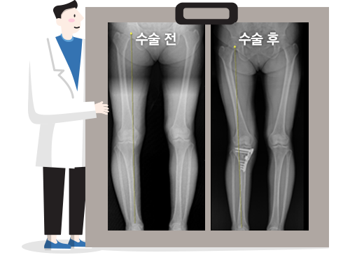 근위 경골 절골술