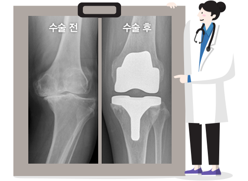 무릎 인공관절 수술