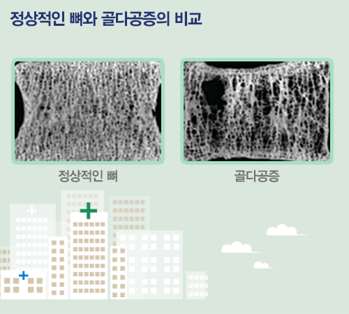 정상적인 뼈와 골다공증의 비교