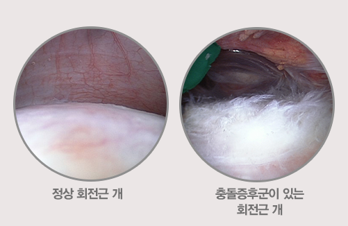 정상 회전근 개와 충돌증후군이 있는 회전근 개