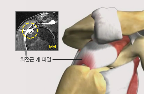 회전근개 파열 MRI사진과 해부 이미지