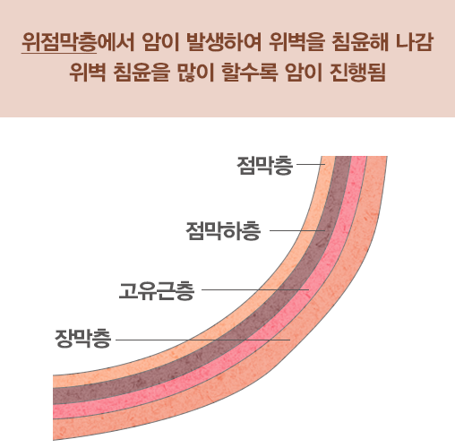 위암의 위험요인