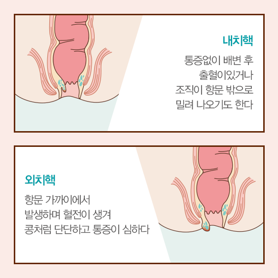 내치핵, 외치핵 정의와 이미지