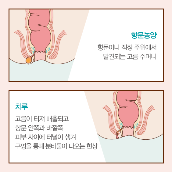 치루, 항문농양의 설명과 이미지