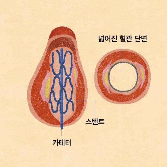 관상동맥 풍선 혈관 성형술 및 스텐트 삽입술 이미지