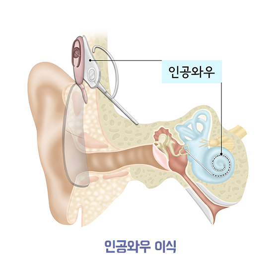 인공와우 인광와우 이식