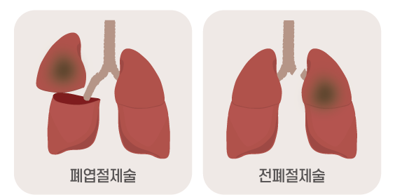 폐엽절제술 전폐절제술 이미지
