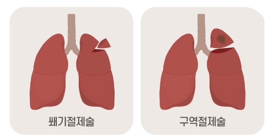 쐐기절제술 구역절제술 이미지
