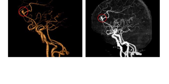 뇌동맥류 CT 사진
