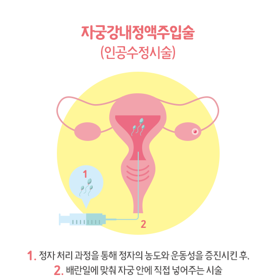 자궁강내정액주입술