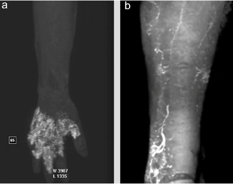 림프부종 치료안내서