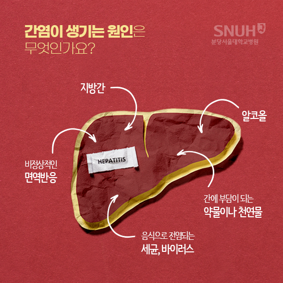 간염이 생기는 원인. 알코올, 간에 부담이 되는 약물이나 천연물, 음식으로 전염되는 세균, 바이러스, 비정상적인 면역반응, 지방간 