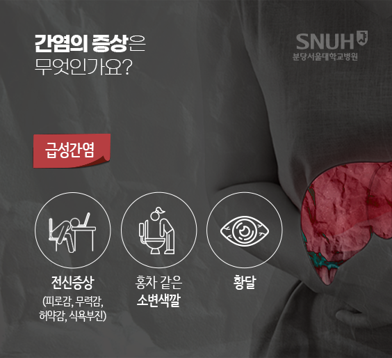 급성간염의 증상은 무엇인가요? 급성간염 - 전신증상(피로감, 무력감, 허약감, 식용부진), 홍차 같은 소변 색깔, 황당