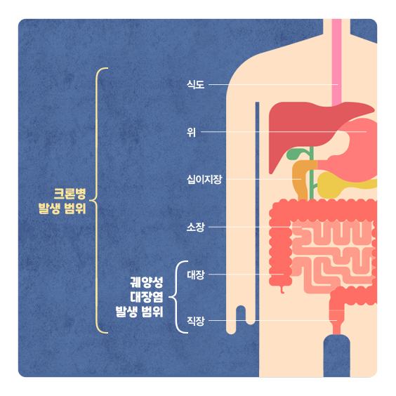 크론병 발생 범위 : 식도, 위 십이지장, 소장, 궤양성 대장염 발생 범위(대장, 직장)