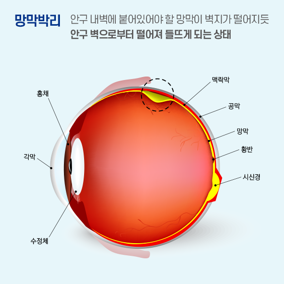 망막박리 : 안구 내벽에 붙어있어야 할 망막이 벽지가 떨어지듯 안구 벽으로 부터 떨어져 들뜨게 되는 상태