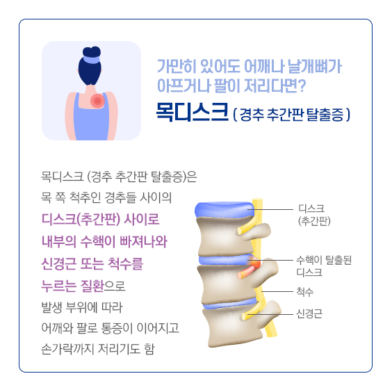 가만히 있어도 어깨나 날깨뼈가 아프거나 팔이 저리다면? 목디스크(경추 추간판 탈출증). 목디스크(경추 추간판 탈출증)은 목 쪽 척추인 경추들 사이의 디스크(추간판)사이로 내부의 수핵이 빠져나와 신경근 또는 척수를 누르느 질환으로 발생 부위에 따라 어깨와 팔로 통증이 이어지고 손가락까지 저리기도 함