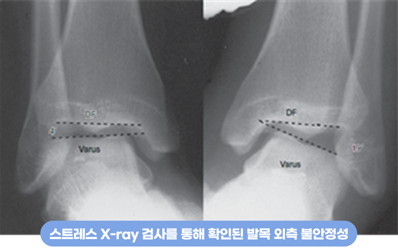 스트레스 X-ray 검사를 통해 확인된 발목 외측 불안정성