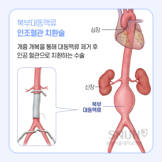 복부대동맥류 인조혈관 치환술