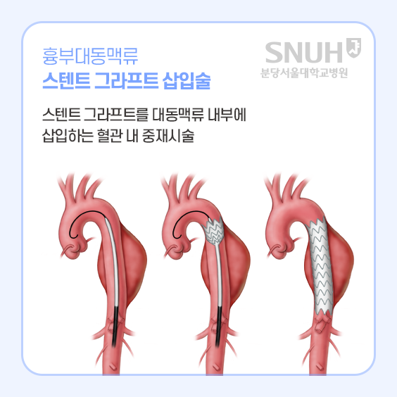 흉부대동맥류 스텐트 그라프트 삽입술