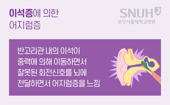 이성증에 의한 어지럼증: 반고리관 내의 이석이 중력에 의해 이동하면서 잘못된 회전신호를 뇌에 전달하면서 어지럼증이 느낌.
