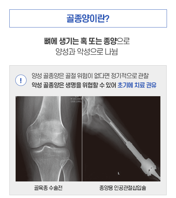 골종양이란? 뼈에 생기는 혹 또는 종양으로 양성과 악성으로 나뉨. 양성 골종양은 골절 위험이 없다면 정기적으로 관찰 악성골종양은 생명을 위협할 수 있어 초기에 치료 권유. 골육종 수술전, 종양용 인공관절삽입술. 