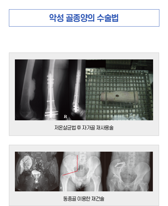 악성골종양의 수술법1. 저온살균법 후 자가골 재사용술. 동종골 이용한 재건술, 