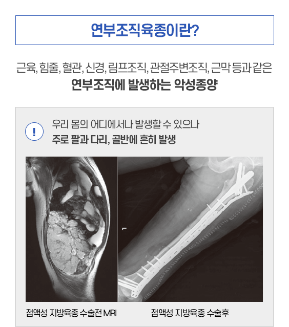 연부조직육종이란? 근육, 힘줄, 혈관, 신경, 림프조직, 관절주변조직, 근막 등과 같은 연부조직에 발새항는 악성종양. 우리 몸의 어디에서나 발생할 수 있으나 주로 팔과 다리, 골반에 흔히 발생.점액성 지방육종 수술전 MRI, 점액성 지방육종 수술후 