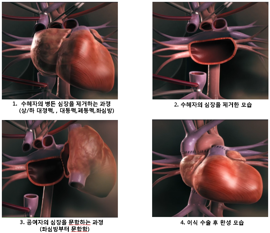 심장 이식수술 모식도