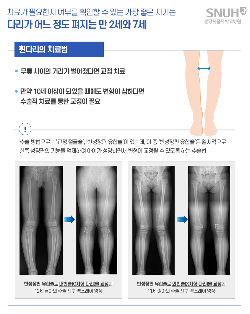 치료가 필요한지 여부를 확인할 수 있는 가장 좋은 시기는 다리가 어느 정도 펴지는 만2세와 7세. 휜다리의 치료법 . 1. 무릎사이의 거리가 벌어졌다면 교정치료 2. 만약 10세 이상이 되었을 때에도 변형이 심하다면 수술적 치료를 통한 교정이 필요. 수술방법으로는 '교정 절골술', '반성장판 유합술'이 있는데, 이중 '반성장판 유합술'은 일시적으로 한쪽 성장판의 기능을 억제하여 아이가 성장하면서 변형이 교정될 수 있도록 하는 수술법. 반성장판 유합술로 내반슬(O자형 다리)을 교정한 12세 남아의 수술 전후 엑스레이 영상. 반성장판 유합술로 외반슬(X자형 다리)을 교정한 11세 여아의 수술 전후 엑스레이 영상