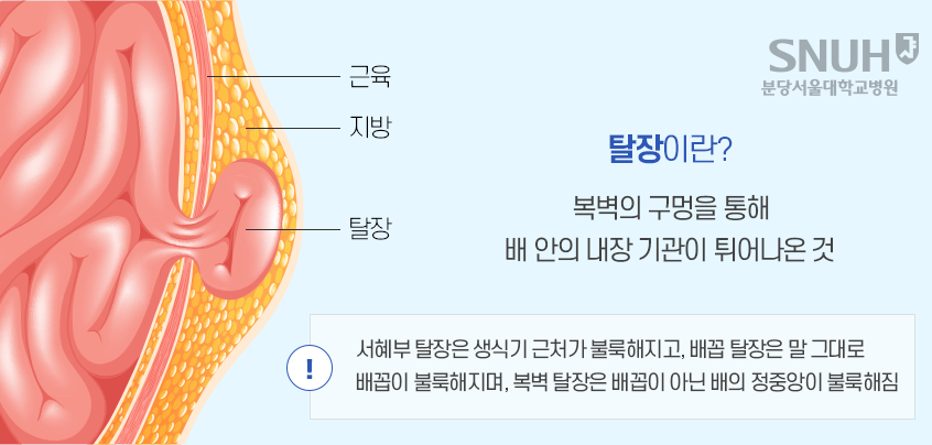 탈장이란? 복벽의 구멍을 통해 배 안의 내장 기관이 튀어나온 것. 서혜부 탈장은 생식기 근처가 불룩해지고 배꼼 탈장은 말 그대로 배꼽이 불룩해지며, 복벽 탈장은 배꼽이 아닌 배의 정중앙이 불룩해짐