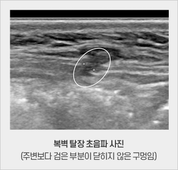  복벽탈장 초음파 사진(주변보다 검은 부분이 닫히지 않은 구멍임)