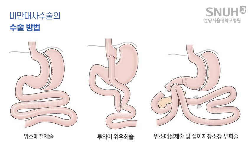 비만대사수술의 수술 방법 : 위소매절제술, 우와이 위우회술, 위소매절제술 및 십이지장소장 우회술