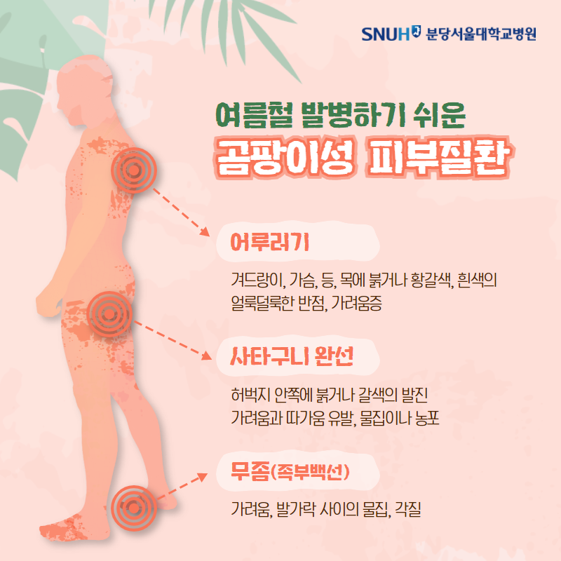 여름철 발병하기 쉬운 곰팡이성 피부질환. 어루러기: 겨드랑이, 가슴, 등 목에 붉거나 황갈새, 흰색의 얼룩덜룩한 반점, 가려움증. 사타구니 완선 : 허벅지 안쪽에 붉거나 갈색의 발진가려움과 따가움 유발, 물집이나 농포. 무좀(족부백선) : 가려움, 발가락 사이의 물집, 각질