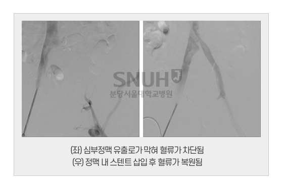 (좌)심부정맥 유출로가 막혀 혈류가 차단됨. (우) 정맥 내 스텐트 삽입 후 혈류가 복원됨