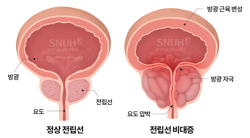 정상전립선 : 방광,요도,전립선, 전립선비대증: 방광근육변성, 요도압박, 방광 자극