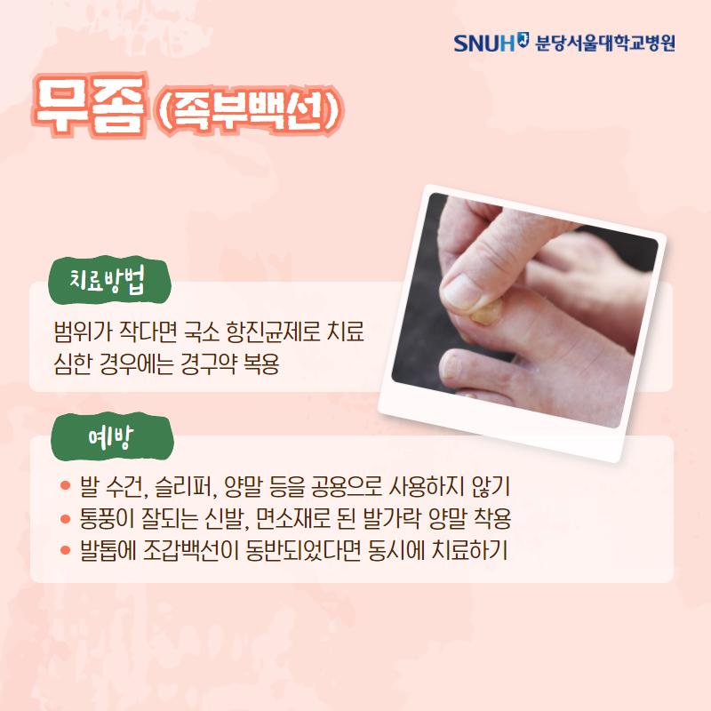 무족(족부백선) 치료방법-범위가 작다면 국소 항진균제로 치료 심한경우에는 경구약 복용. 예방-발수건 슬리퍼, 양말 등을 공용으로 사용하지 않기, 통풍이 잘되는 신발, 면소재로 된 발가락 양말 착용, 발톤에 조갑색선이 동반되었다면 동시에 치료하기