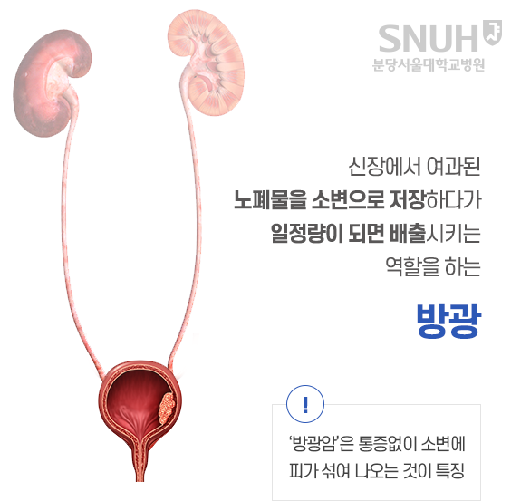 신장에서 여과된 노폐물을 소변으로 저장하다가, 일정량이 되면 배출시키는 역할을 하는 방광. '방광암'은 통증이 없이 소변에 피가 섞여 나오는 것이 특징